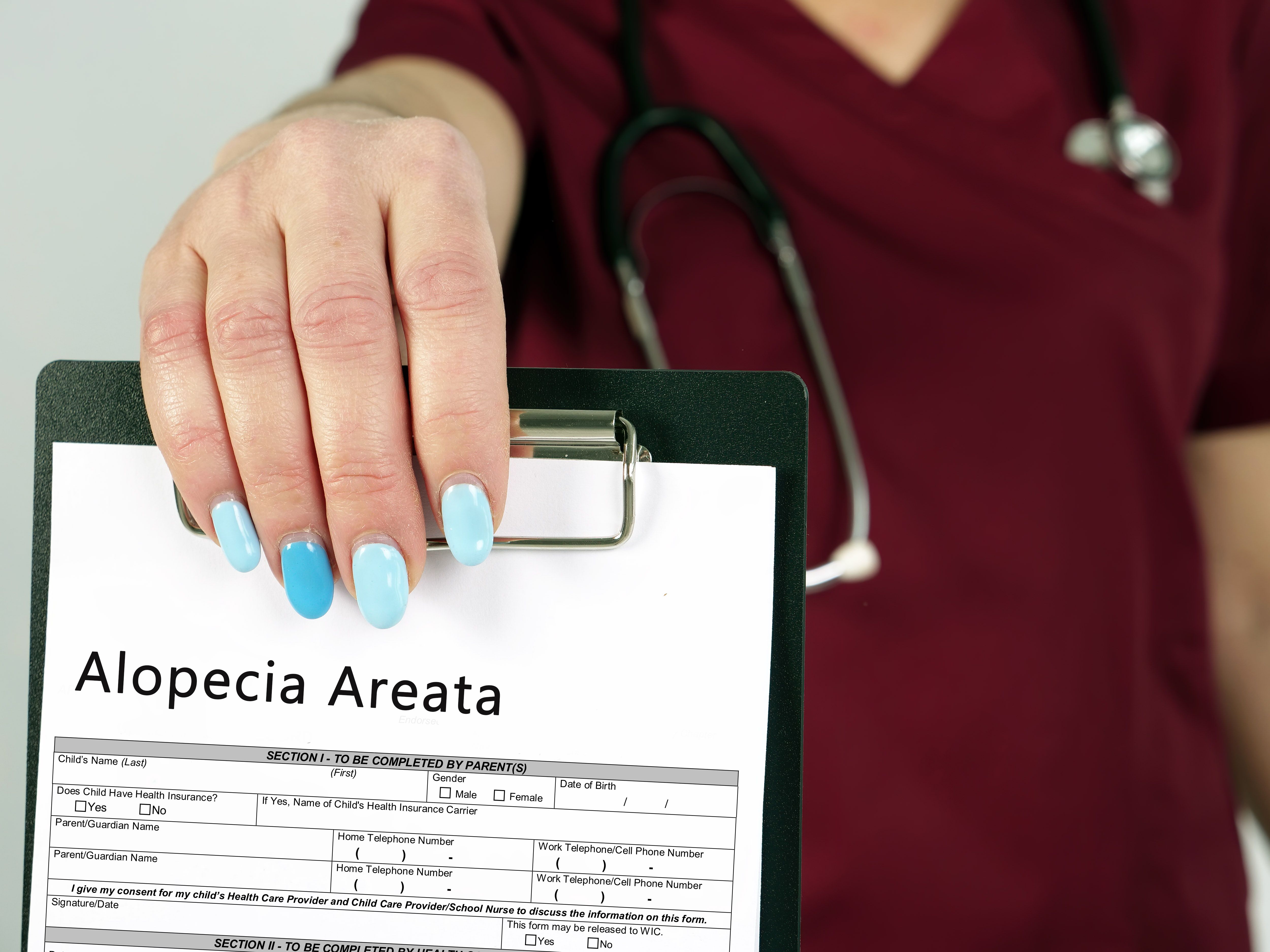 Alopecia areata. | Image Credit:  Yurii Kibalnik -  stock.adobe.com 