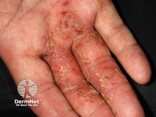 Cracking the Code on Chronic Hand Eczema
