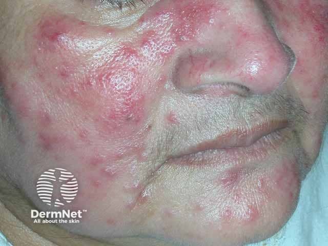 Minocycline Foam Significantly Improves Papulopustular Rosacea Outcomes