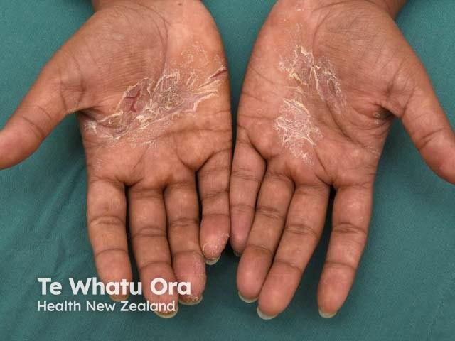 New Study Evaluates Accuracy of Hand Eczema Self-Assessments