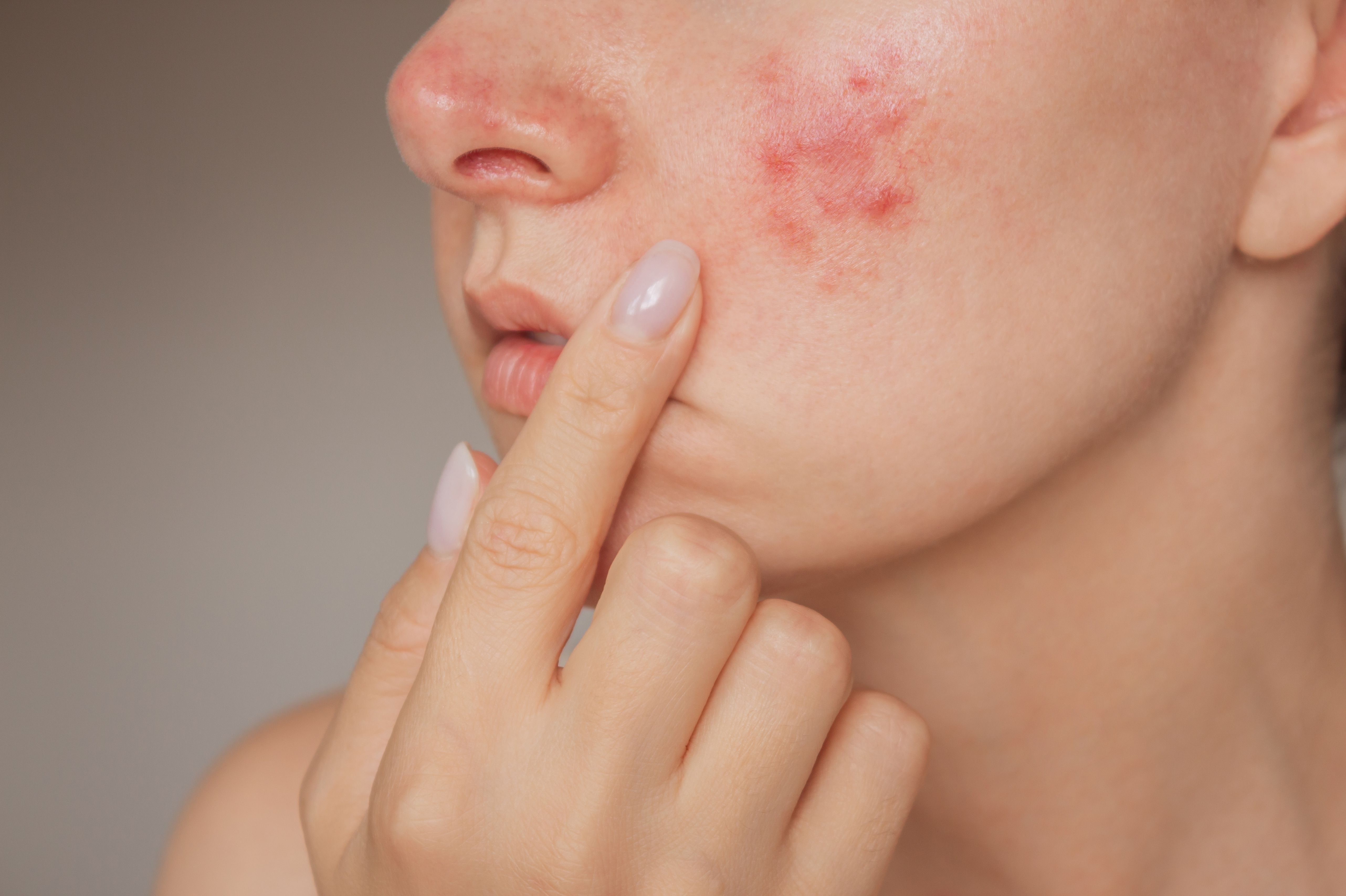 Compound Heparin Sodium Allantoin Gel Can Treat Rosacea and Improve Skin Barrier