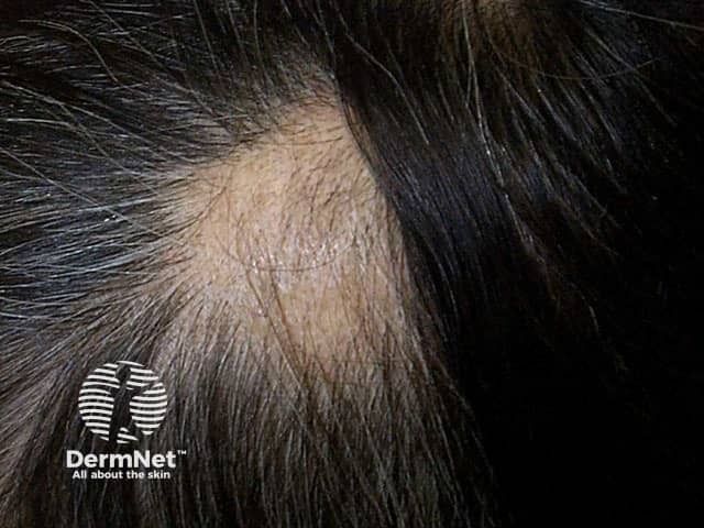 Nearly Half of Patients Respond to Ritlecitinib for Alopecia Areata, With Most Sustaining Results